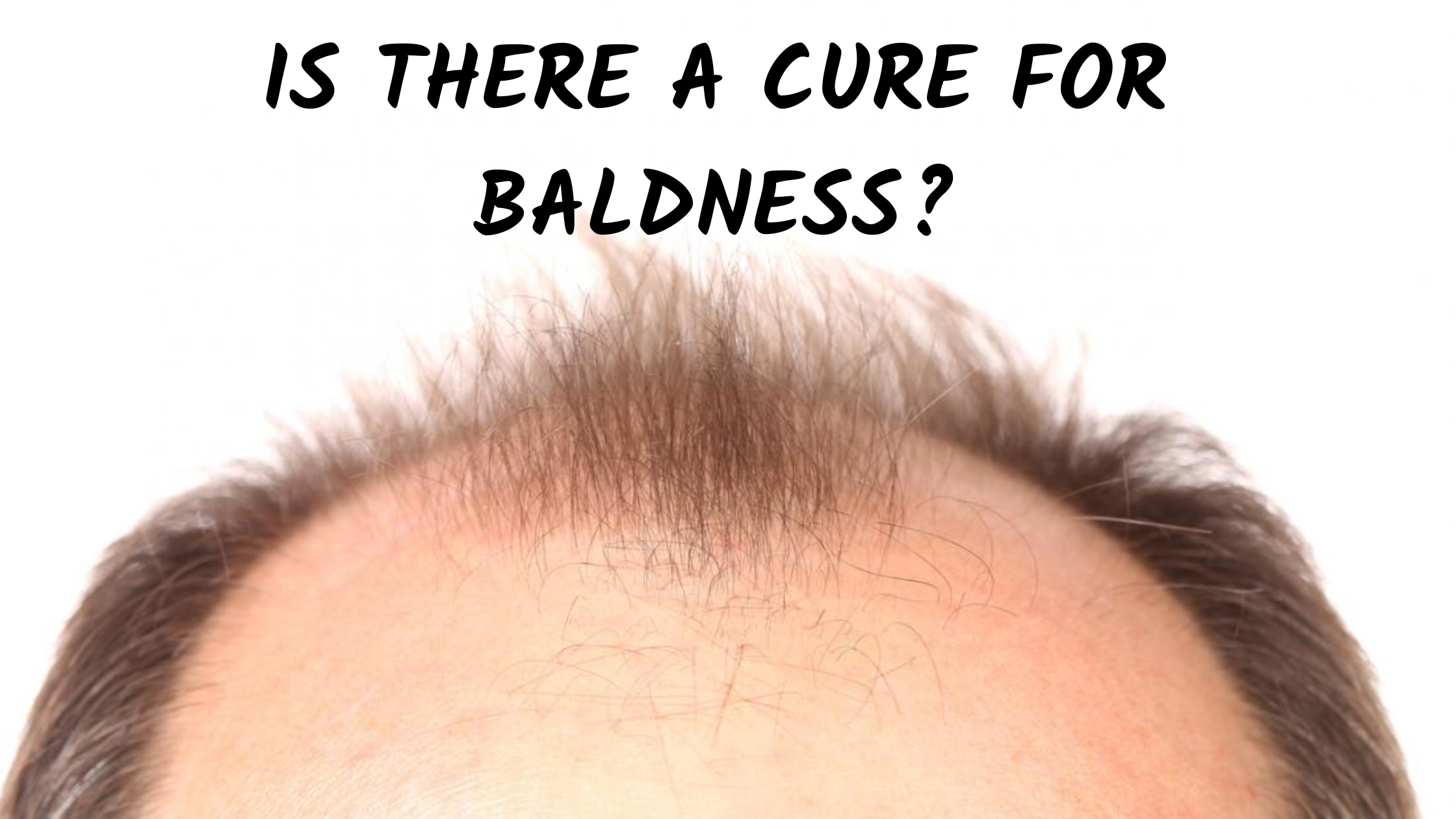 Is there a cure for Baldness? Let'sLive